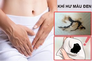 Ra khí hư màu đen – Nguyên nhân do đâu?