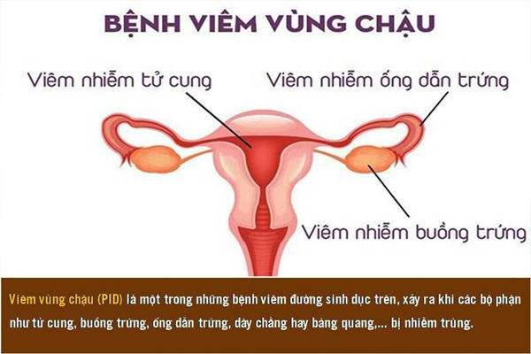 Đau bụng dưới sau mỗi cuộc “yêu”có thể là dấu hiệu bệnh viêm vùng chậu