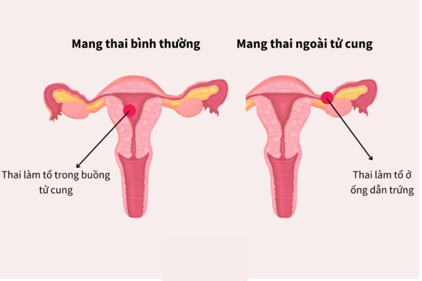 Thai-ngoai-tu-cung (1)